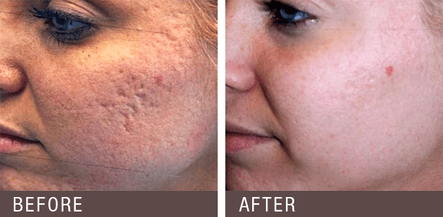 Facial treatment New Jersey