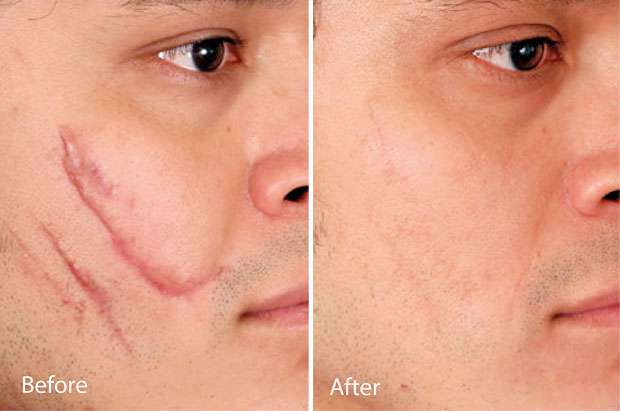 Laser Treatments for Scars